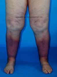 Chronic Venous Insufficiency and Lymphedema - Lymphedema Therapy
